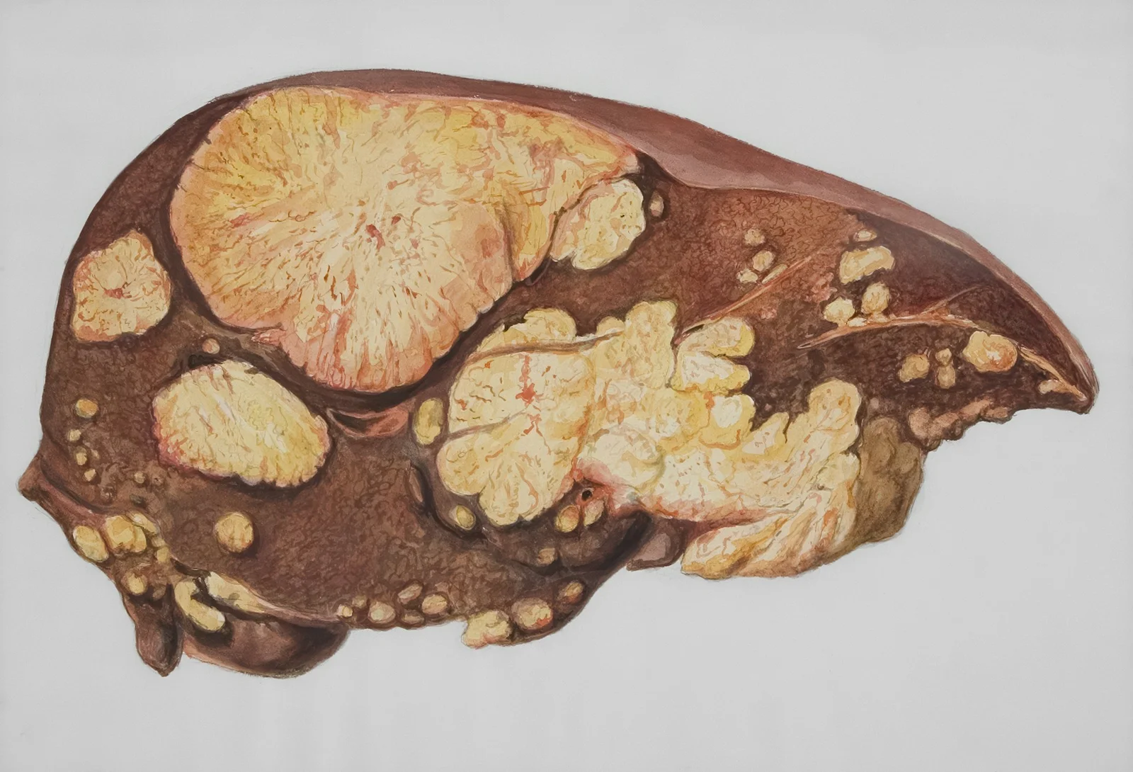 Is Dalia Good for Fatty Liver?